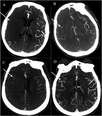 Prognostic Value of a New Integrated Parameter—Both Collateral Circulation and Permeability Surface—in Hemorrhagic Transformation of Middle Cerebral Artery Occlusion Acute Ischemic Stroke: Retrospective Cohort Study